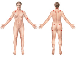 Fibromialgia2